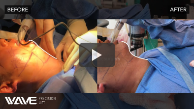 Precision Lift Before and After Video